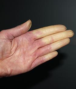 Lindra Raynauds fenomen med Warmly Handvärmare: En värmekälla för bättre livskvalitet - Warmly